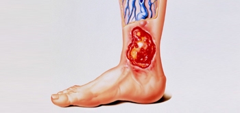 Varis Ülseri Tedavi Edilebilir Mi?